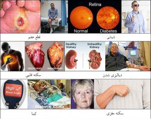 عوارض دیابت