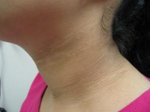 بیماری Acanthosis nigricans